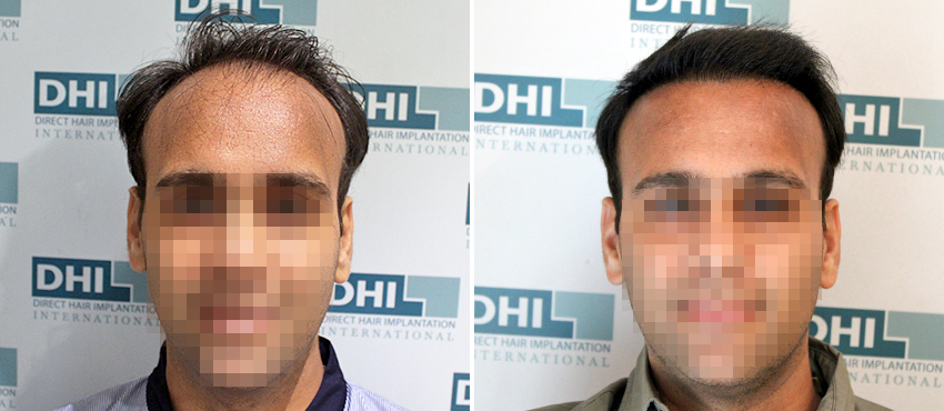 DHI before & after hair transplant results